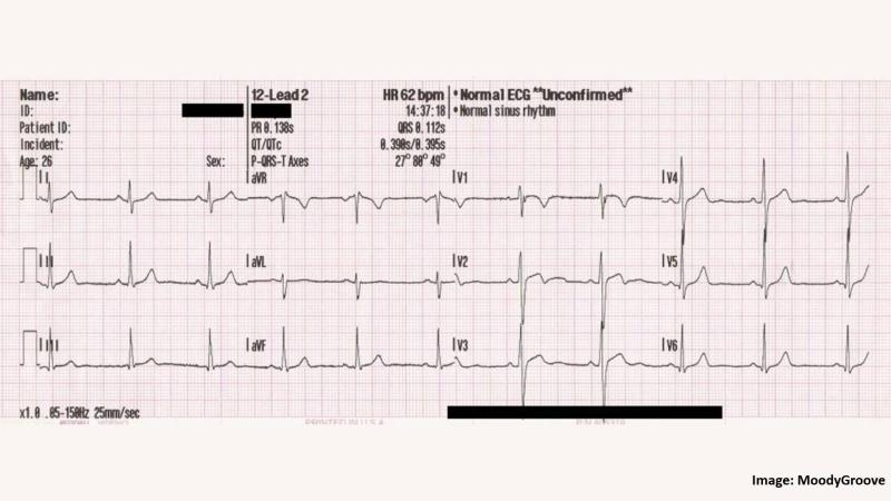 QR code based patient data protection in ECG steganography