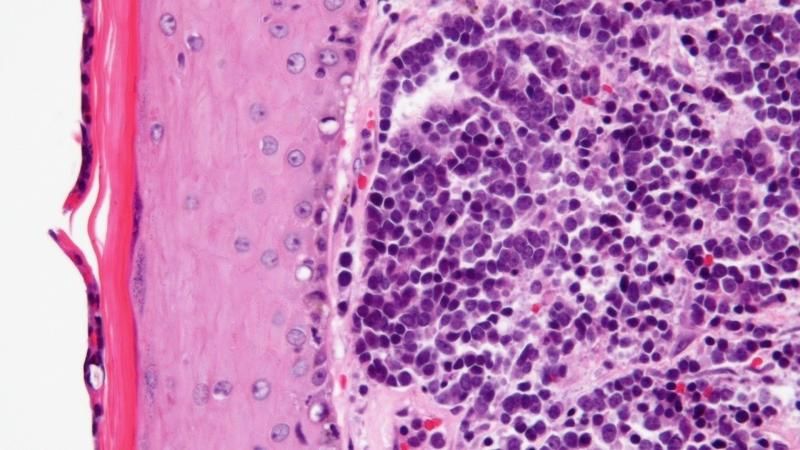 First-ever study in India investigates a rare type of cancer caused by a virus