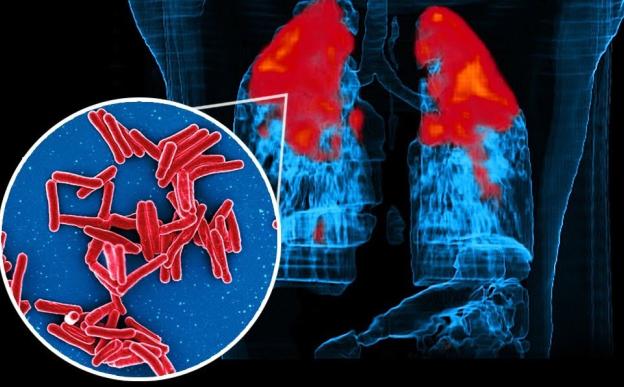 क्षयरोगास कारणीभूत मायकोबॅक्टेरियम ट्युबरक्युलॉसिस जीवाणू 