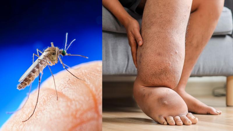 A mosquito and a person affected with elephantiasis