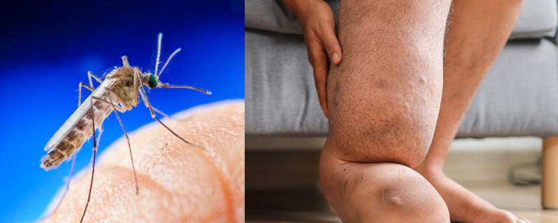 A mosquito and a person affected with elephantiasis