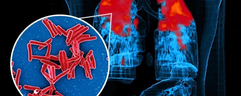 Mycobacterium Tuberculosis Bacteria, the Cause of TB