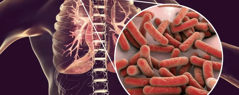 Can Mass Screenings Be the Key to Eradicating TB?