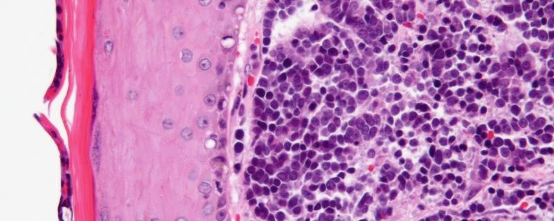 First-ever study in India investigates a rare type of cancer caused by a virus